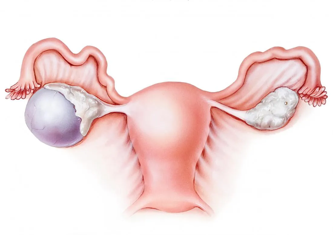 Best gynecologist in Delhi for ovarian cyst explains how to get rid of Ovarian Cyst?