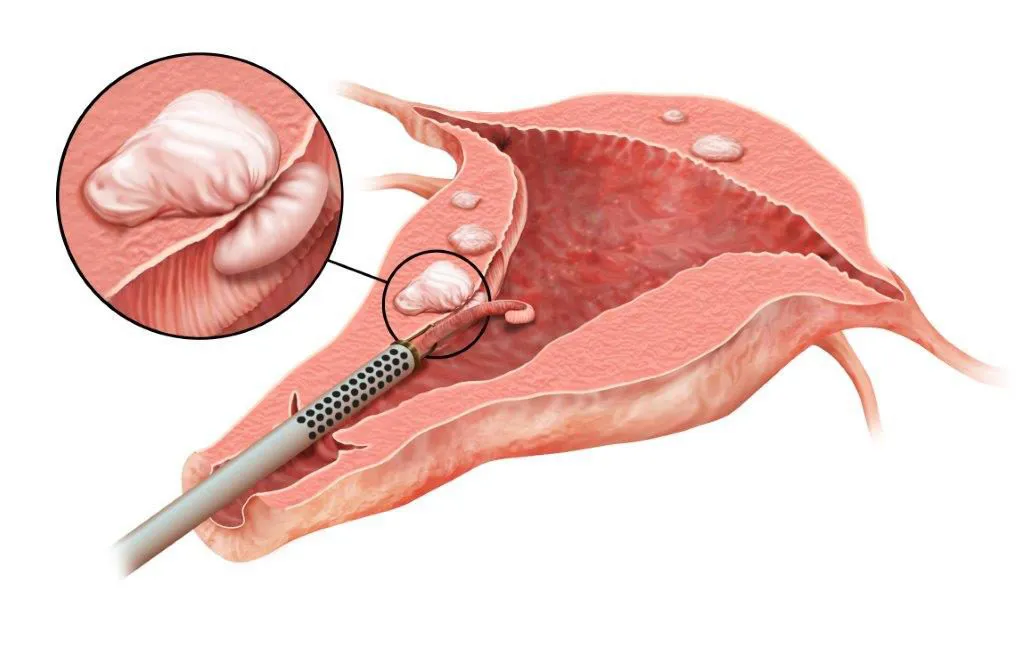 Tips for Conceiving after a Myomectomy!