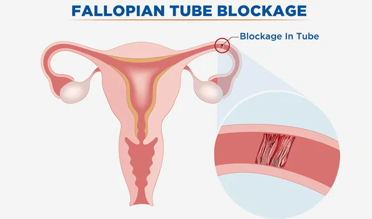 How to Get Pregnant with Blocked Fallopian Tubes?