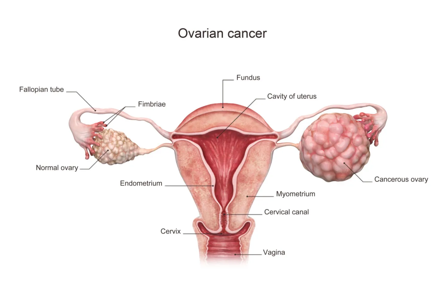Everything you need to know about Ovarian Cysts