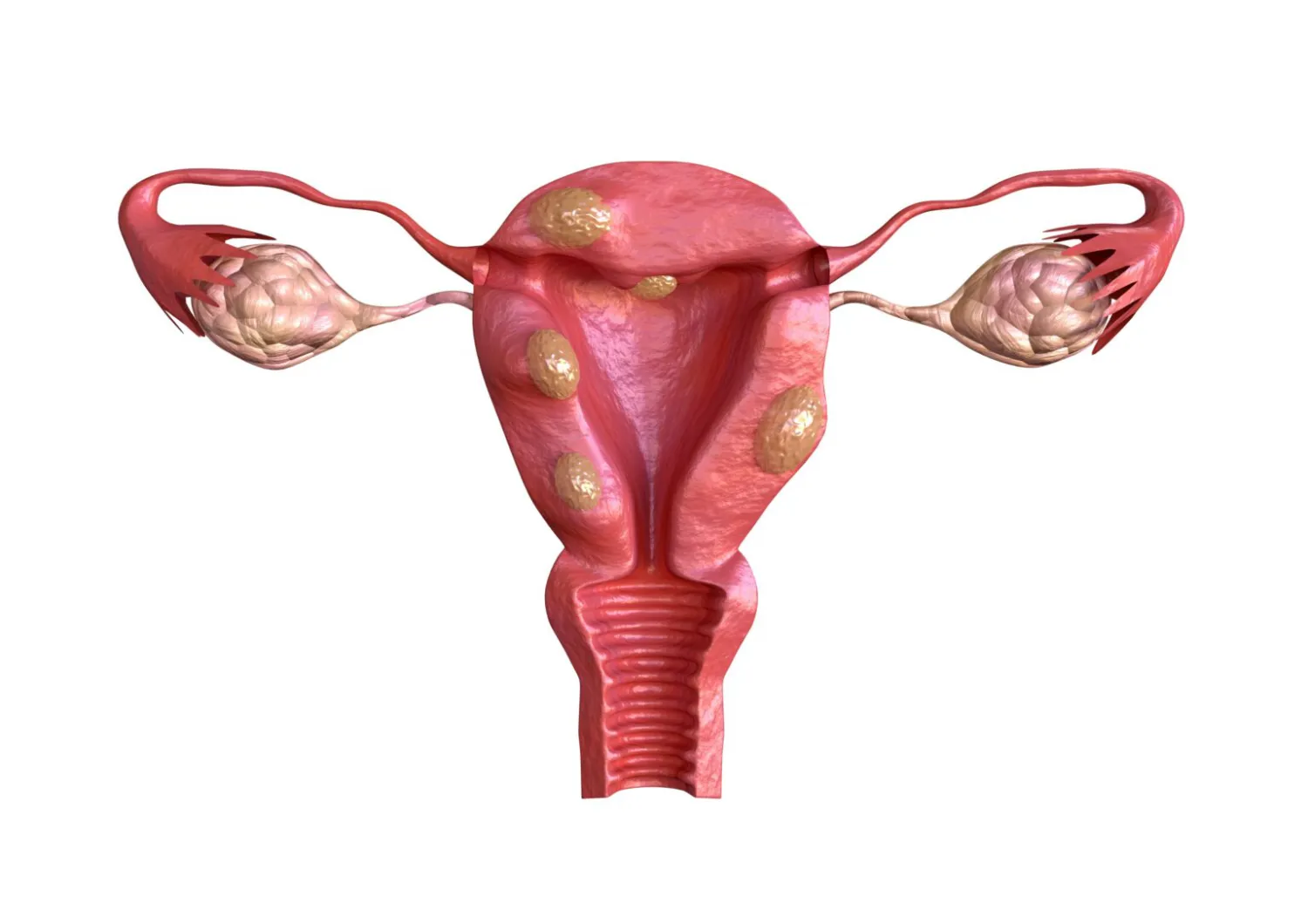 What are Uterine Fibroids?An Article by best doctor for Uterine Fibroids in Delhi