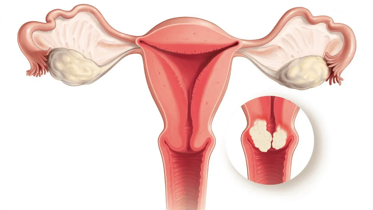 Are you prepared to fight Cervical Cancer?