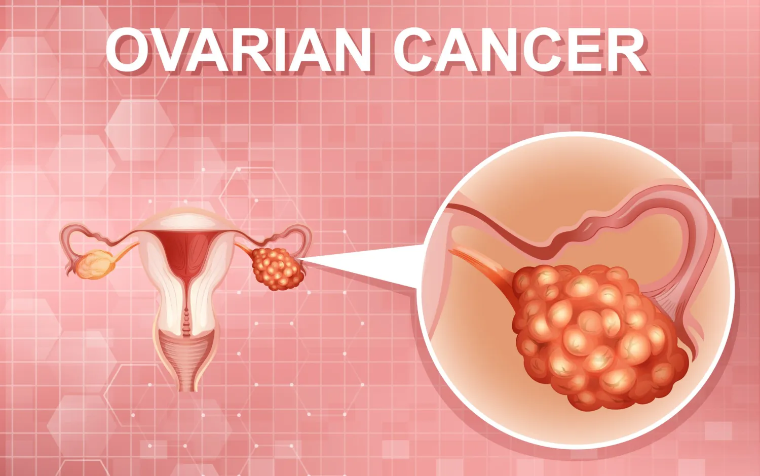 Can Ovarian Cancer be prevented?