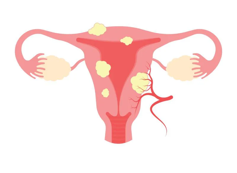 Tips to get relief from Uterine Fibroids
