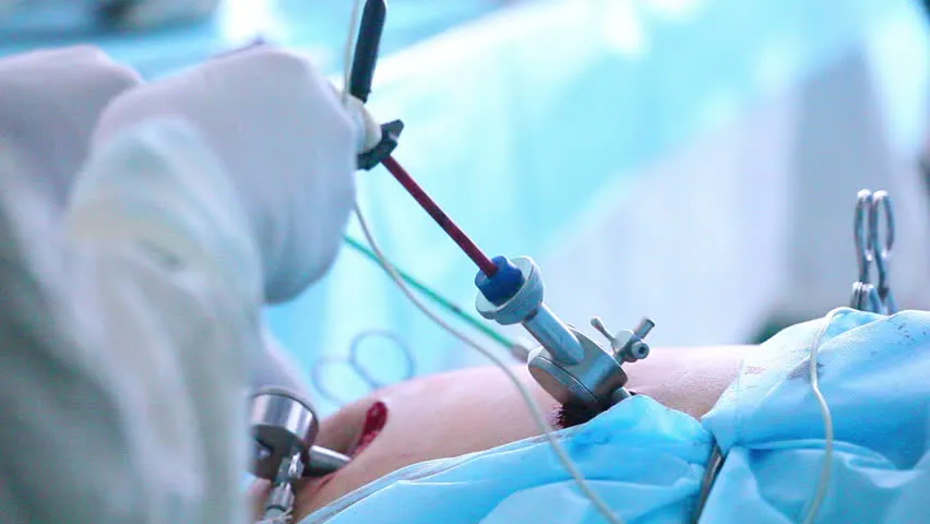 Everything You Need to Know about Laparoscopic Surgery