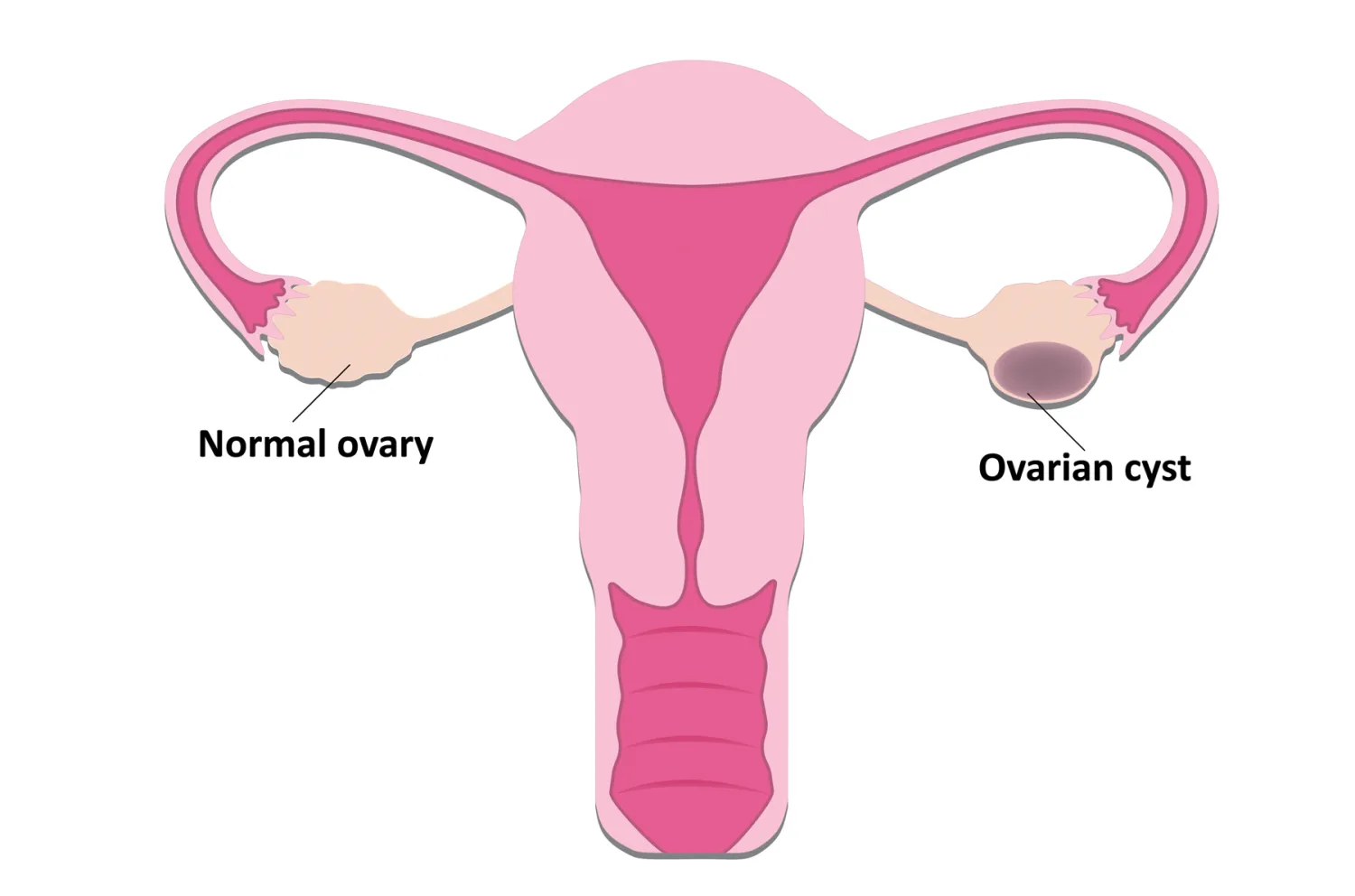 Best Ovarian Cyst treatment in Delhi