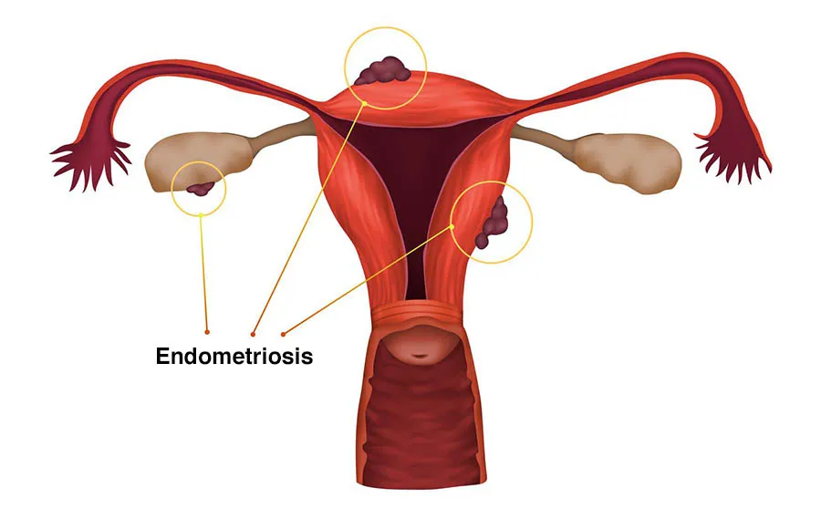 Here’s all you need to know about endometriosis