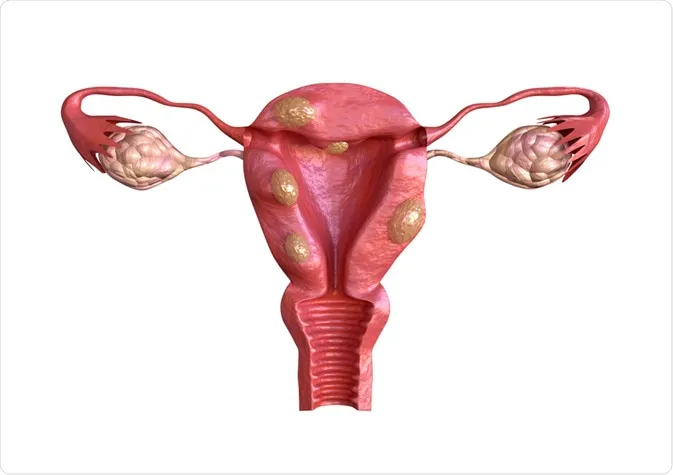 What Every Woman Must Know about Fibroid Tumors