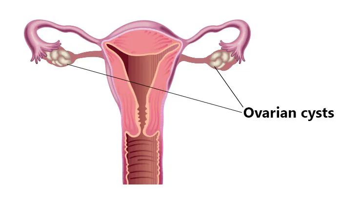 Why you need the best gynecologist in Delhi for Ovarian Cyst
