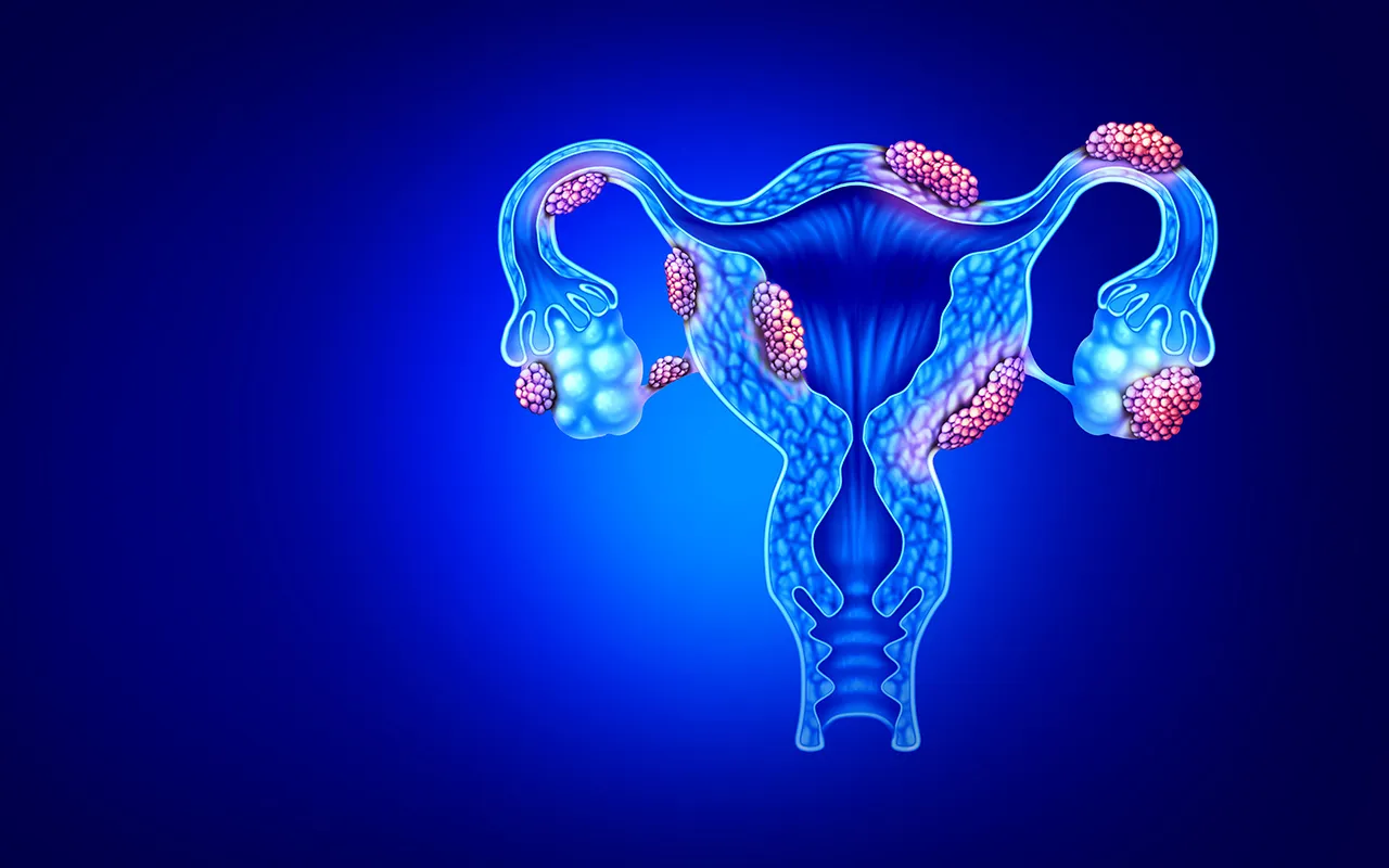 Understanding Endometriosis: Expert Insights from the Best Gynecologist in Delhi - Blog Image