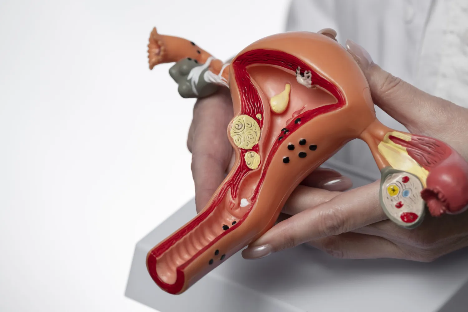 Understanding Uterine Fibroids: Causes, Symptoms, and Treatment Options - Blog Image