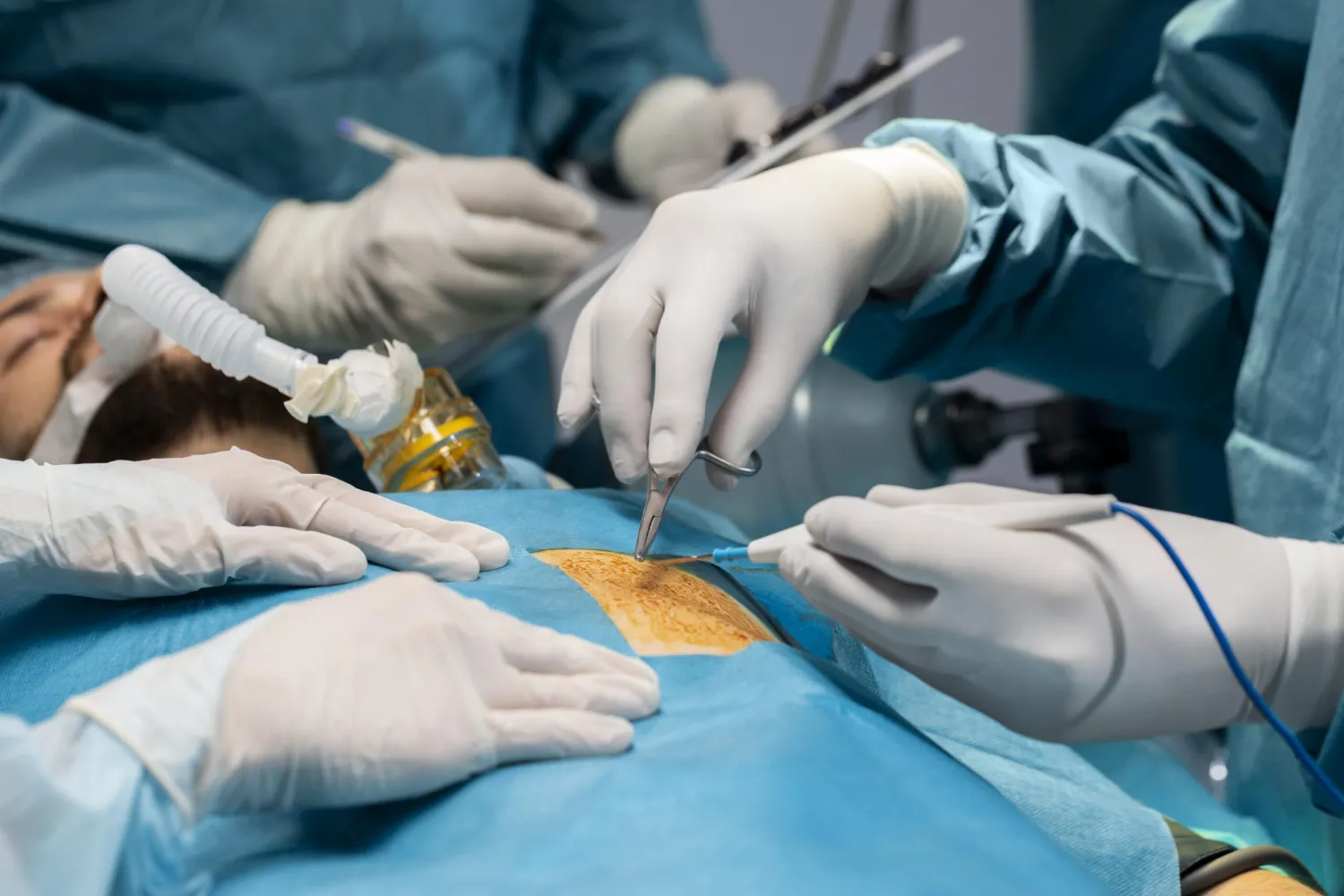 The Purpose, Treatment, And Benefits Of Laparoscopic Surgery - Blog Image