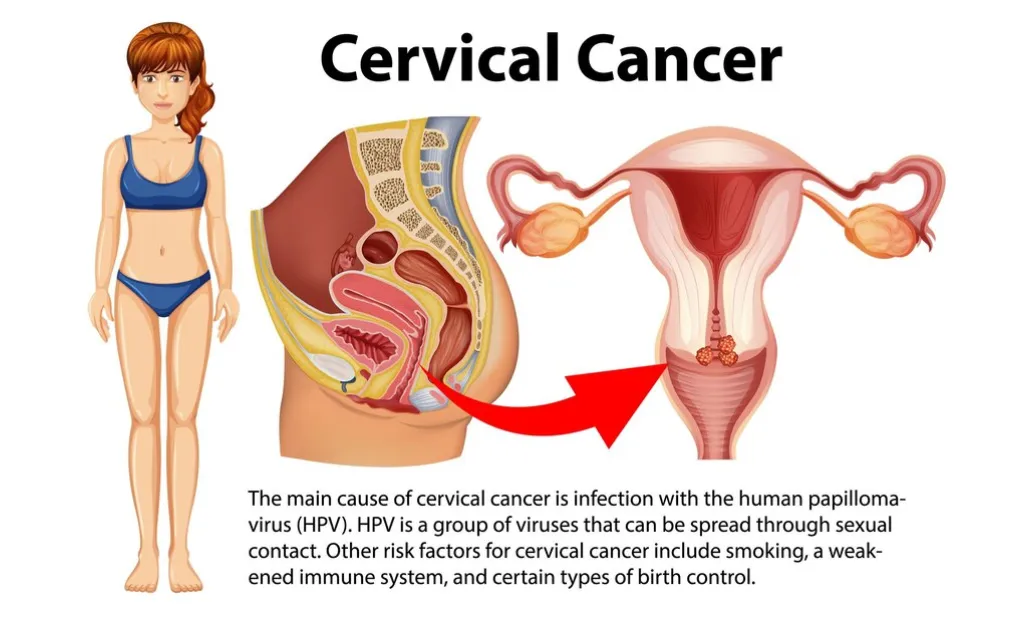 Understanding the Signs of Cervical Cancer: A Guide for Women - Blog Image