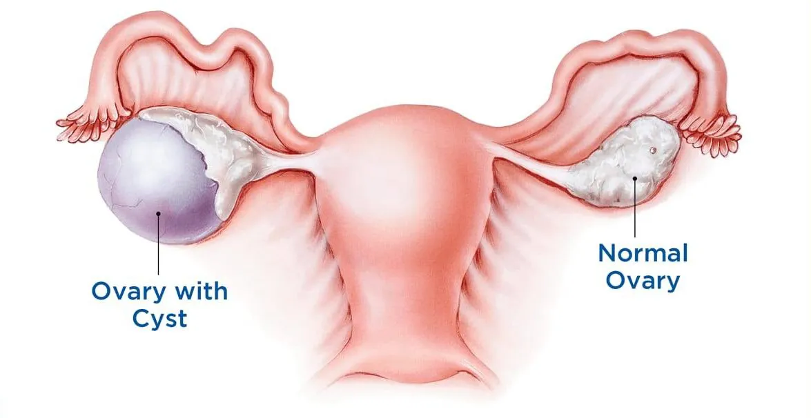 Minimally Invasive Surgery for Ovarian Cysts: What You Need to Know - Blog Image