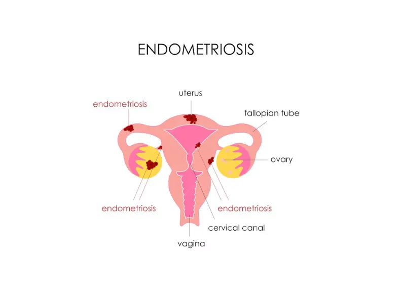 Endometriosis: Symptoms, Diagnosis, and Treatment Options - Blog Image
