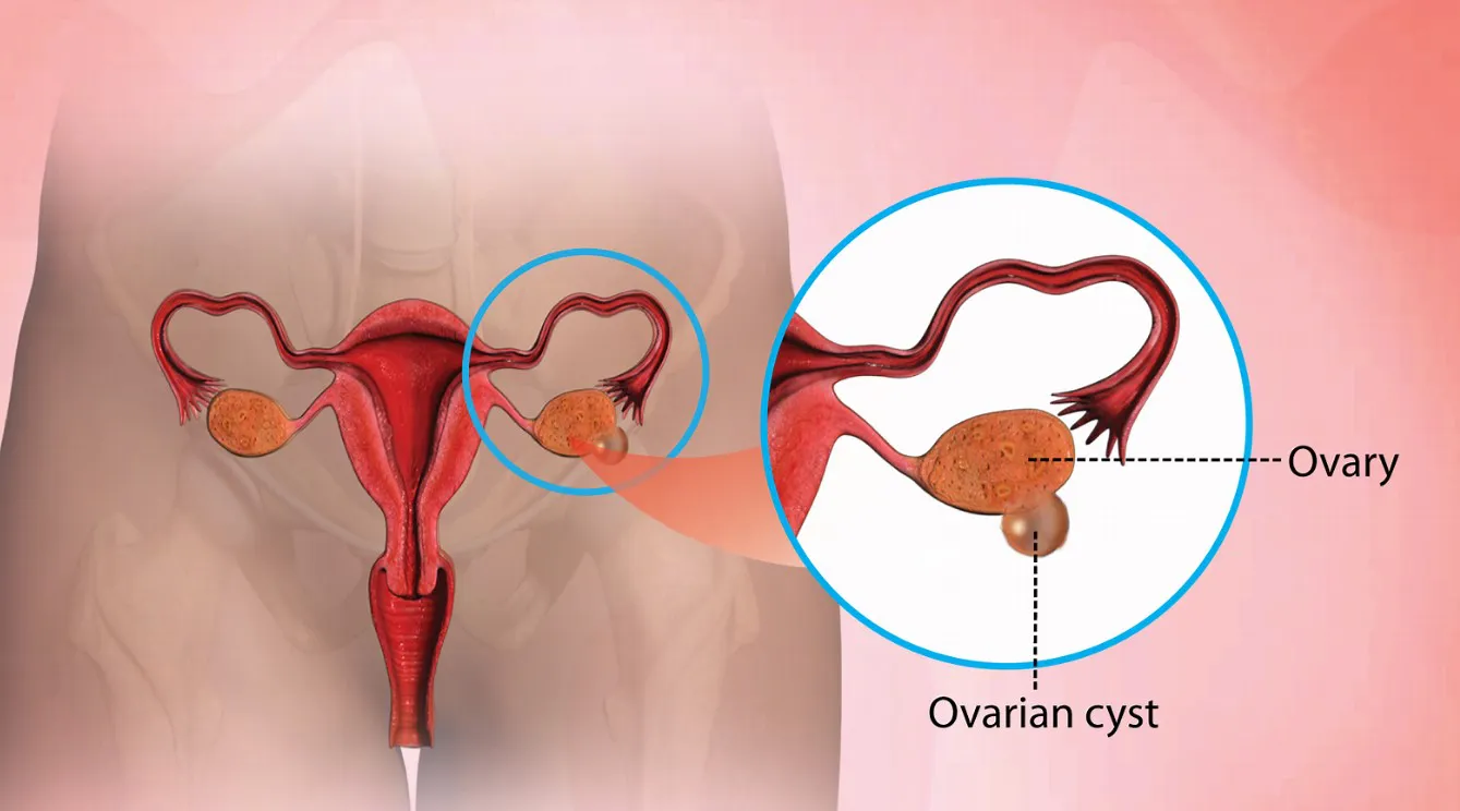 What is Ovarian Cyst: Symptoms, Causes, and Treatment - Blog Image