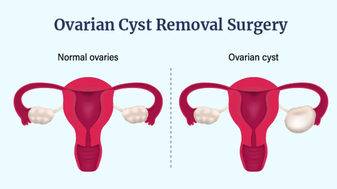 How Robotic Surgery Helps in Treating Ovarian Cysts Safely - Blog Image