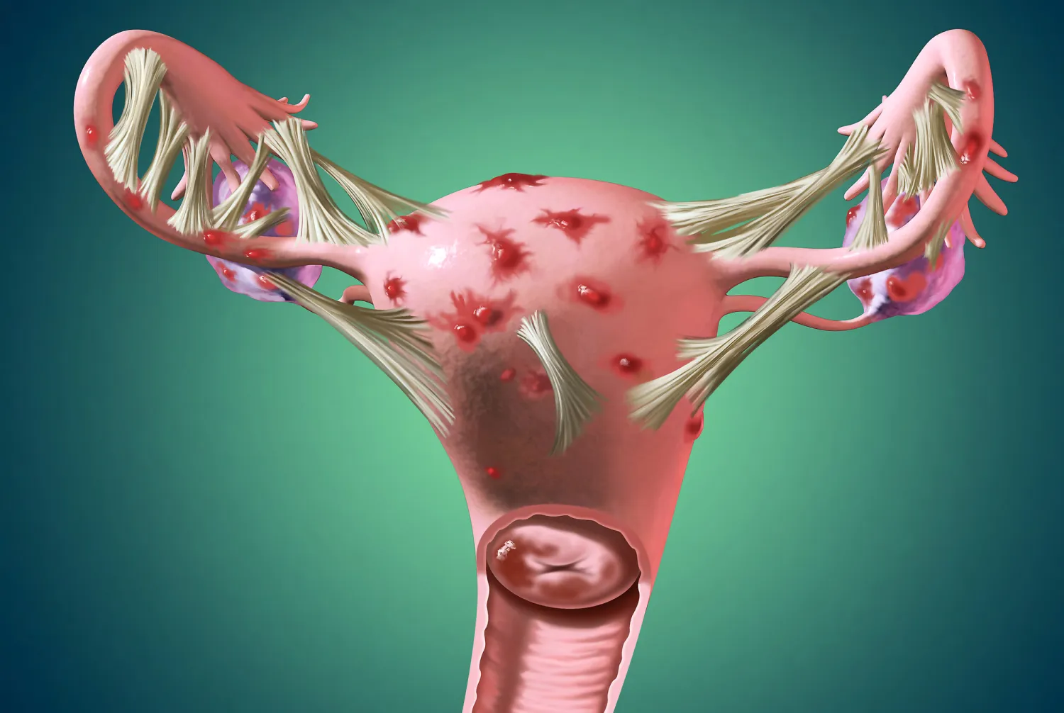 Endometriosis Ureterolysis: Advanced Surgical Care by Dr. Usha M Kumar - Blog Image