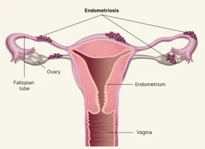 Endometriosis: The Silent Epidemic Every Woman Must Know About