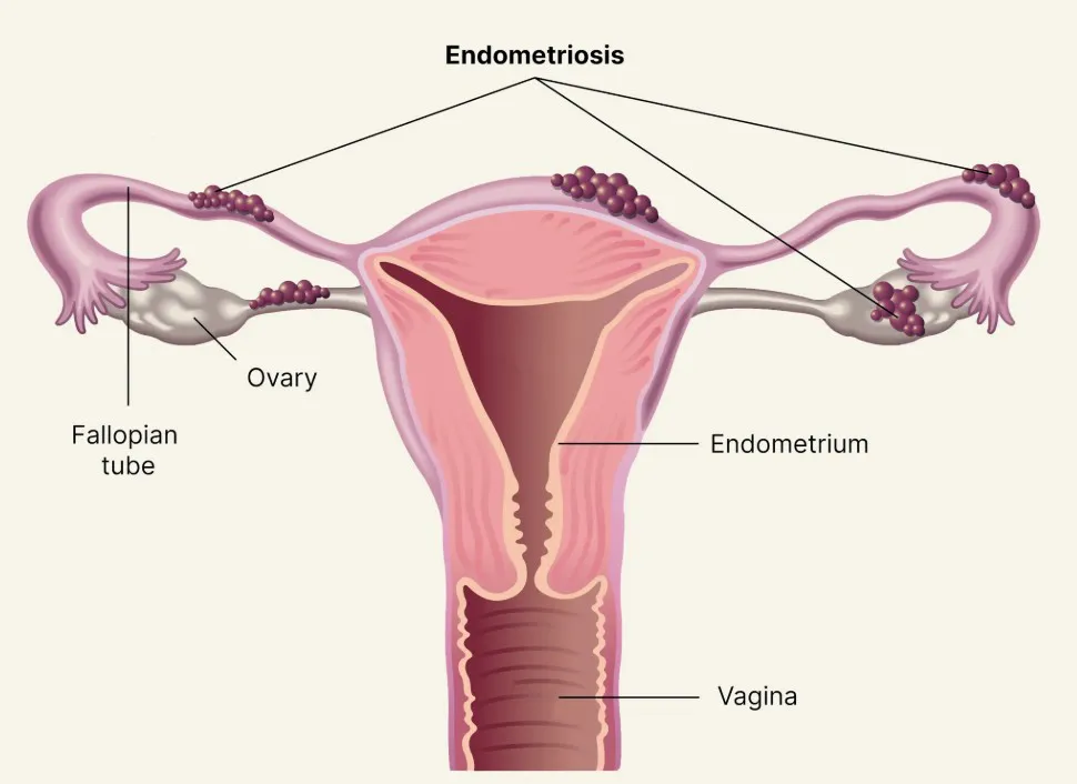 Endometriosis: The Silent Epidemic Every Woman Must Know About - Blog Image