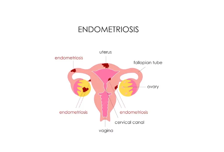 Endometriosis Awareness: Managing Symptoms and Fertility Concerns - Blog Image