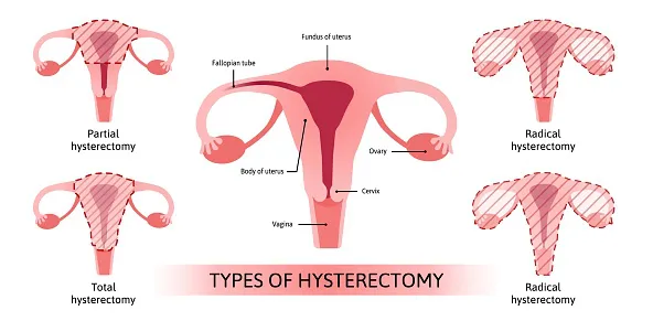 Uterus Removal Surgery (Hysterectomy)
