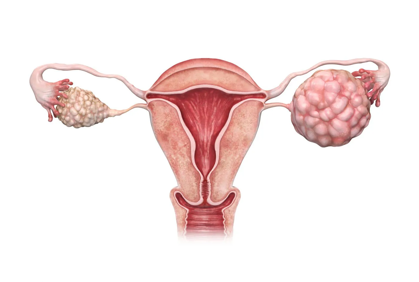 Ovarian Cancer