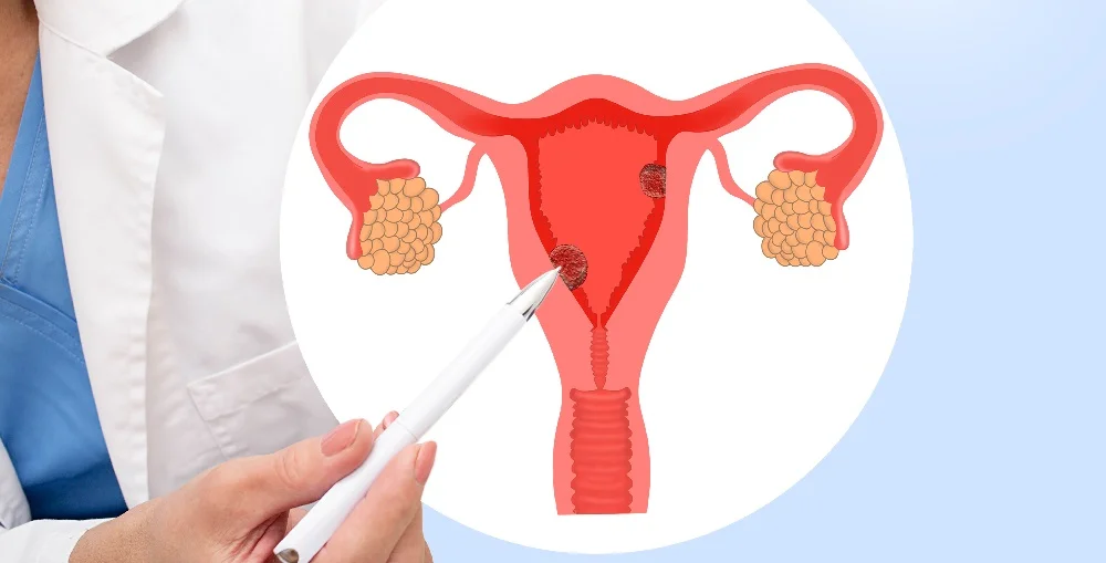 Endometrial Cancer