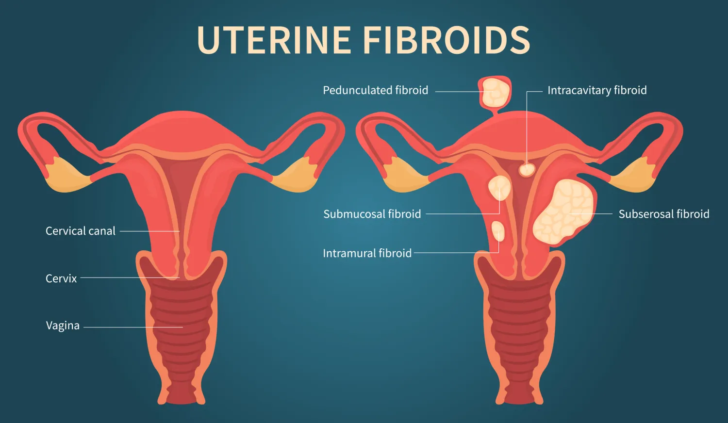 Uterine Fibroid Surgery